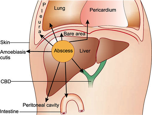Successful Surgical Management of a Rare Hepatico-Broncho-Pleural Fistula in Hubli